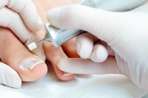 Лікування екземи нігтів: ефективна методика