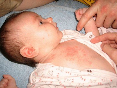 Алергічний висип на шкірі у дорослого: як виглядає, лікування висипання