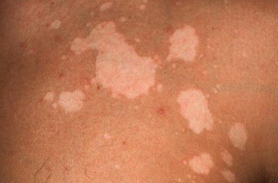 Білі пігментні плями на шкірі: чому зявляються на тілі, лікування білих точок