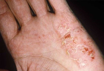 Чому тріскається шкіра на пальцях рук: лікування, що робити якщо лущитися і сохне