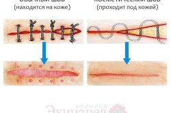 Шви після операції і як від них позбавитися
