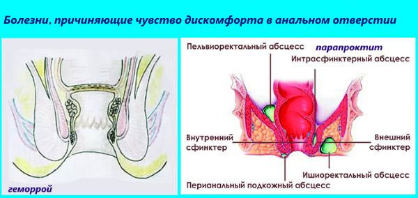 Причини появи відчуття тиску в ділянці анального отвору