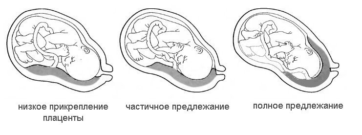 Низьке розташування плаценти при вагітності (прикріплення, передлежання, розташування)   що робити майбутній мамі?
