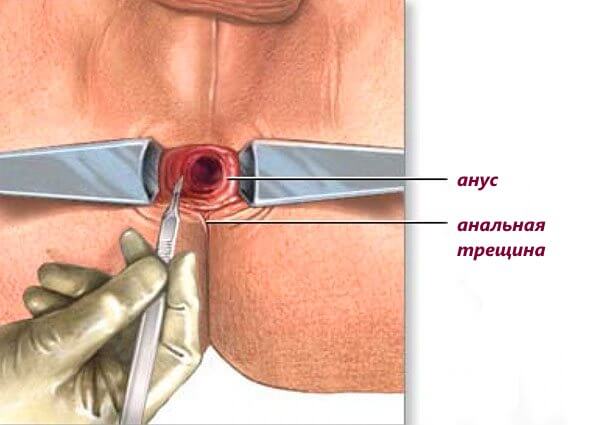 Анальна тріщина: причини виникнення, симптоматика, методи лікування