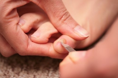 Жовті нігті на великих пальцях ніг: звідки вони беруться?