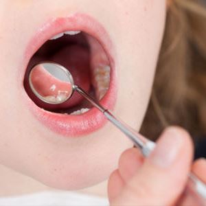 Лікування молочниці в роті у дитини народними засобами і препаратами. Причини і симптоми захворювання.