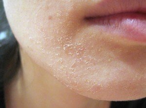 Почервоніння і лущення шкіри обличчя