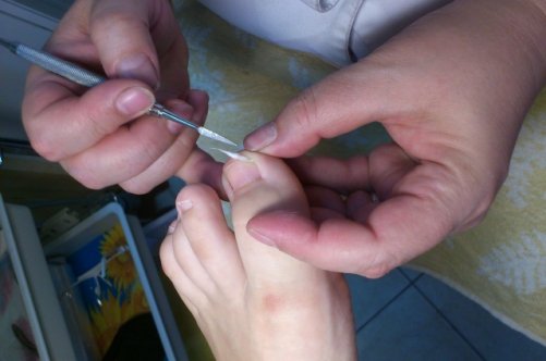 Современные методы лечения вросших ногтей на ногах