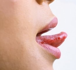 Пухирі на язику: Причини, Лікування, Пухирі на губах