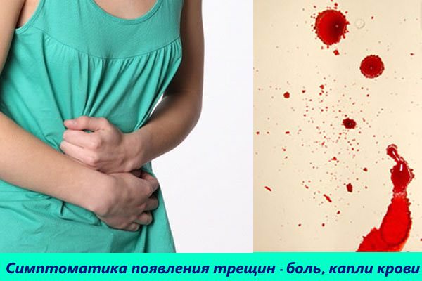 народні засоби від тріщин в задньому проході