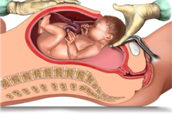 Епідуральна анестезія при кесаревому розтині: протипоказання, наслідки, можливі ускладнення (відео)