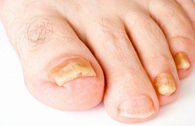 Лікувати грибок на ногах і ступнях: як виглядає, симптоми, ознаки грибка