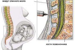 Епідуральна анестезія при кесаревому розтині: протипоказання, наслідки, можливі ускладнення (відео)