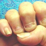 Як перестати гризти нігті | Як перестати гризти нігті дітям Як перестати гризти нігті | Як перестати гризти нігті дітям