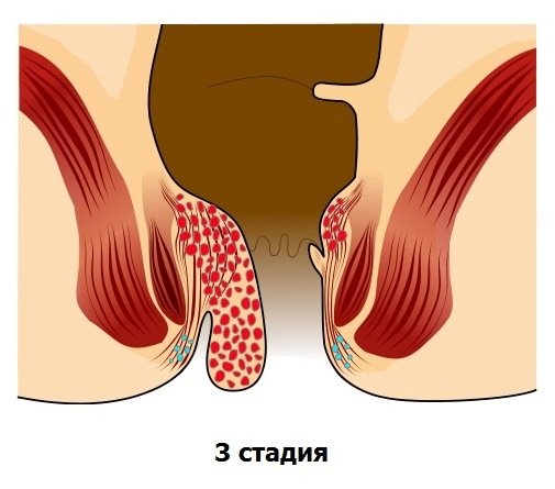 Як лікувати тромбоз зовнішнього гемороїдального вузла