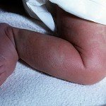 Еритема новонароджених   види, причини, симптоми, діагностика, лікування, фото