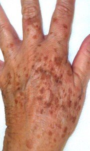 Коричневі плями на шкірі: причини і лікування