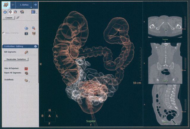 Віртуальна колоноскопія кишечника: що це таке, відгуки, як проводиться