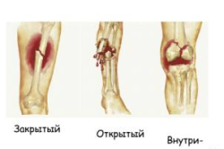 Операції на нозі: види хірургії нижніх кінцівок (відео)