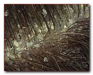 Як вибрати шампунь від лупи Як вибрати шампунь від лупи