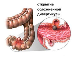 Симптоматика та лікування дивертикулеза