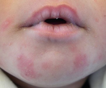Алергічний контактний дерматит: симптоми і лікування