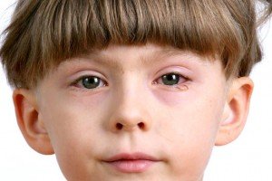 Червоні очі у дитини: причини і лікування