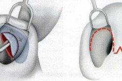 Операції на ніс: показання та протипоказання, відкрита, закрита і повторна ринопластика