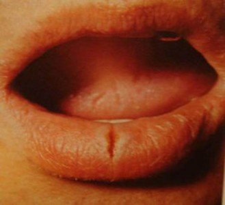 Чому тріскаються куточки рота (губи), лущитися шкіра: причини сухості