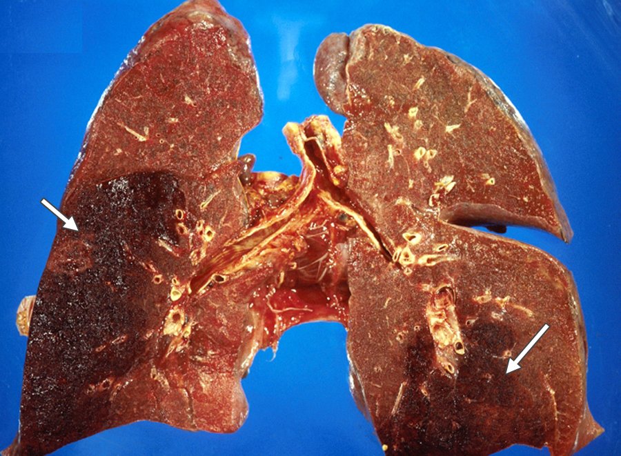 Легенева емболія: причини, симптоми і лікування