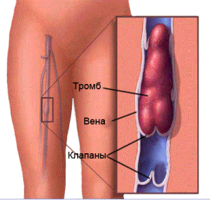 Лікування тромбофлебіту: актуальні методи