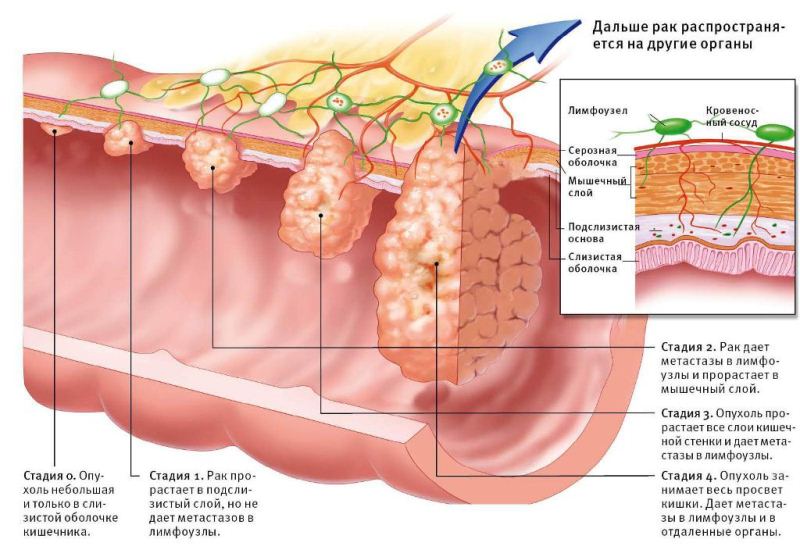 Рак прямої кишки: симптоми, причини, ознаки