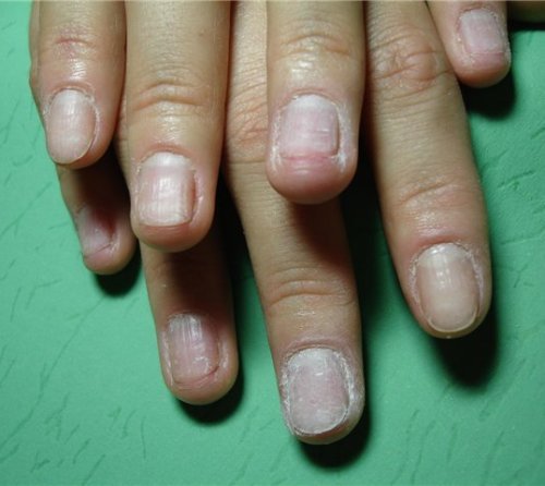 Наслідки після нарощування нігтів: гелевого, акрилового