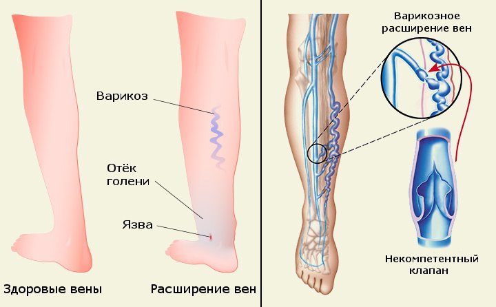 Профілактика варикозу вен на ногах: дві схеми, їх дія