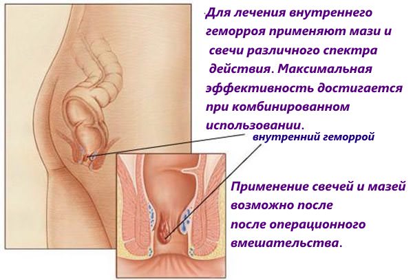 Лікування геморою кращими супозиторіями