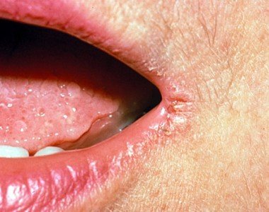 Чому тріскаються куточки рота (губи), лущитися шкіра: причини сухості
