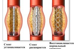Операція стентування судин серця: показання, післяопераційна реабілітація (відео)