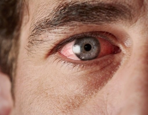 Втома очей   симптоми і причини; лікування синдрому народними засобами і вправами