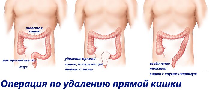 Як проводять операцію з видалення прямої кишки