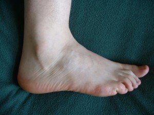 Артрит стопи: особливості, симптоми і лікування