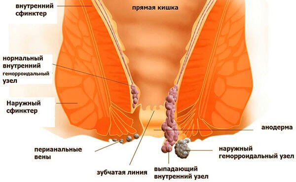Підступність геморою – його скритність