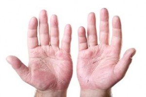 Свербіння між пальцями рук: причини, лікування та профілактика