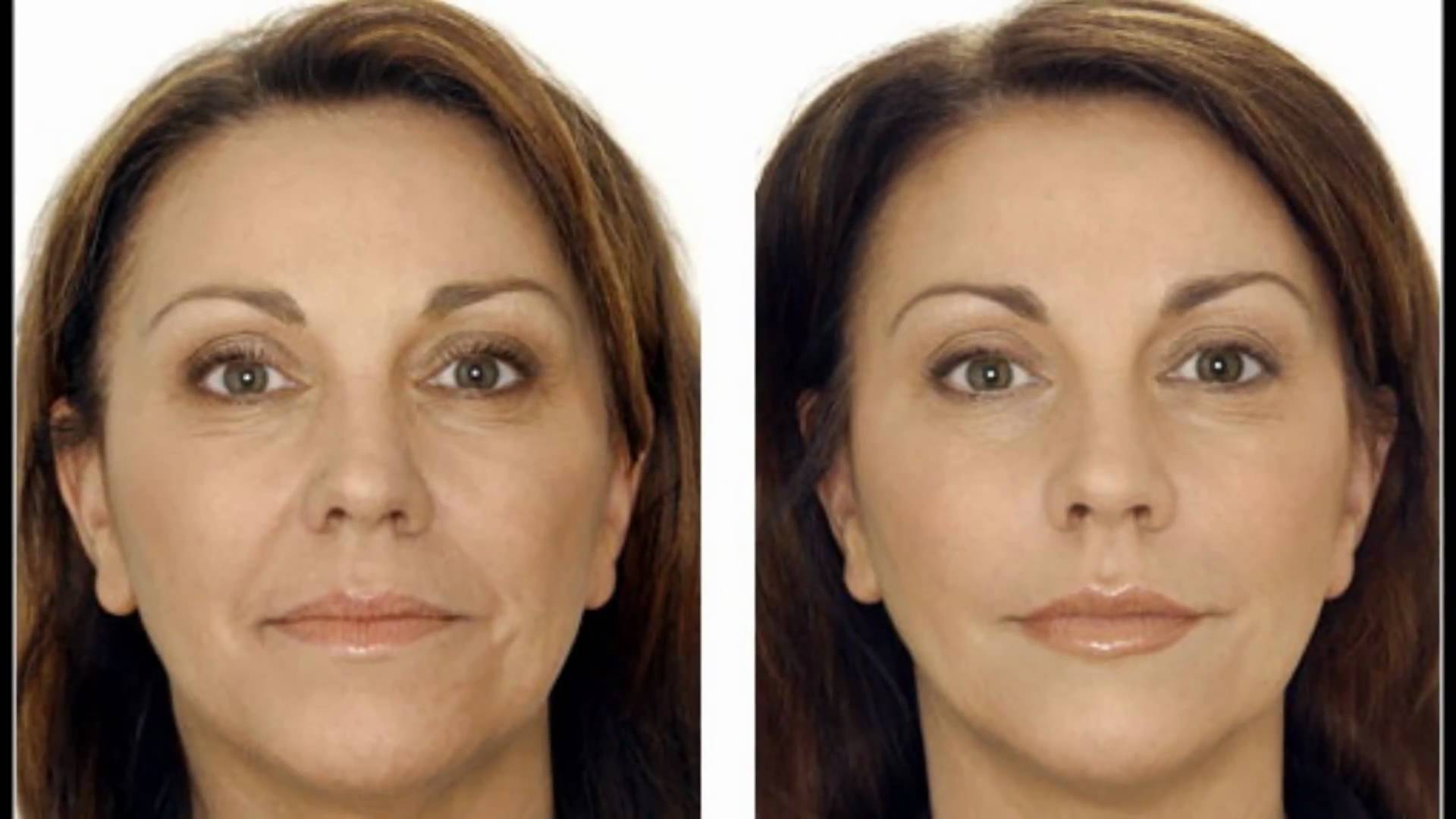 Як позбутися від зморшок на обличчі