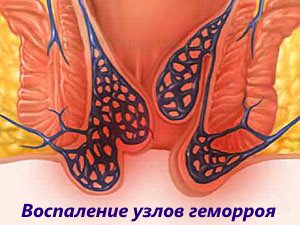 Чи можна вживати спиртне при варикозі гемороїдальних вузлів