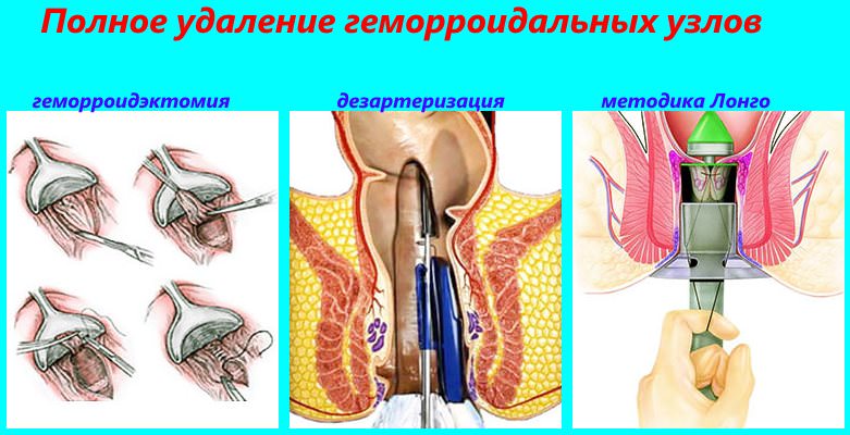 Якими способами проводять видалення геморою