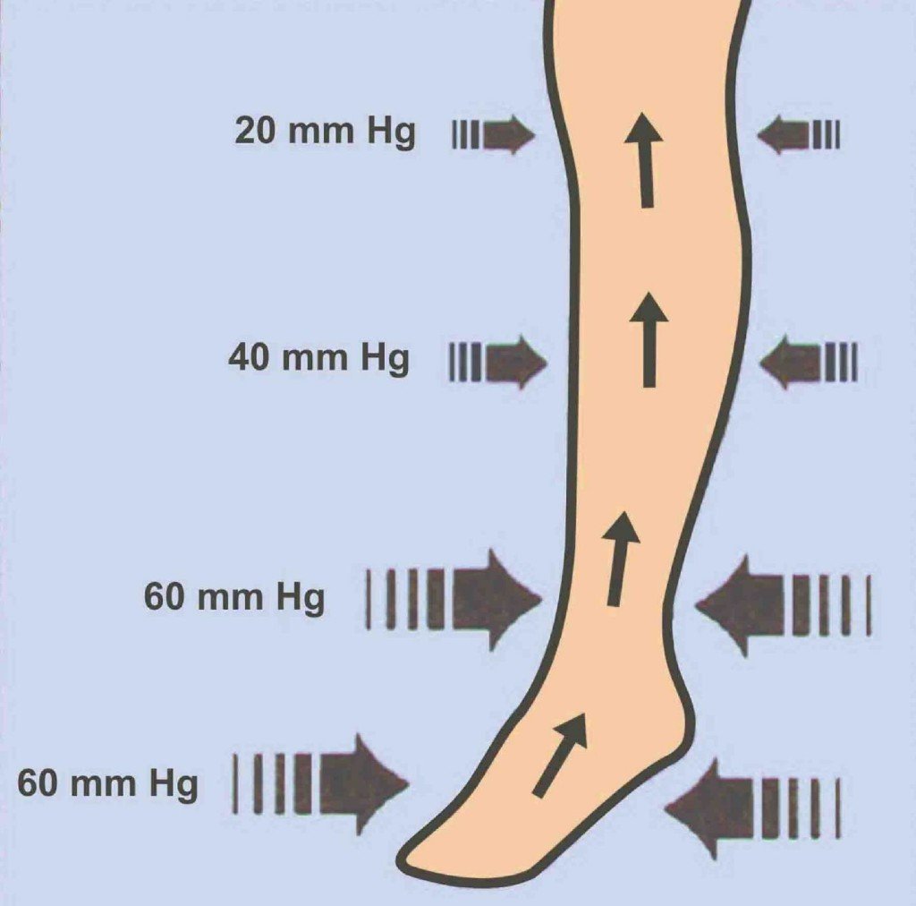 Еластичний бинт при варикозі: нюанси використання