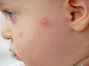 Алергія у вигляді комариних укусів