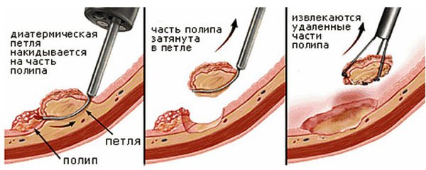 У прямій кишці виявлені поліпи