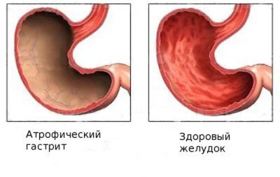 Атрофічний гастрит шлунка (хронічний, вогнищевий, антральний): причини, симптоми, лікування