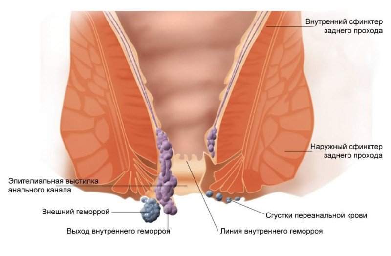 Як лікувати тромбоз зовнішнього гемороїдального вузла